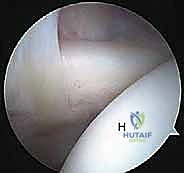 صورة طبية: إصلاح وتر تحت الكتف بالمنظار في صنعاء: دليل شامل من الأستاذ الدكتور محمد هطيف