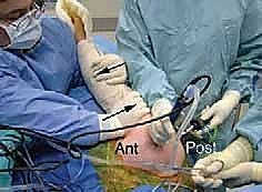 صورة طبية: إصلاح وتر تحت الكتف بالمنظار في صنعاء: دليل شامل من الأستاذ الدكتور محمد هطيف