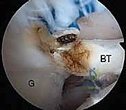 صورة طبية: إصلاح وتر تحت الكتف بالمنظار في صنعاء: دليل شامل من الأستاذ الدكتور محمد هطيف