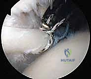 التمزقات التنكسية في أوتار الكتف