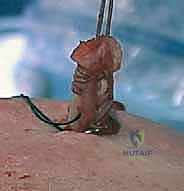 صورة طبية: إصلاح وتر تحت الكتف بالمنظار في صنعاء: دليل شامل من الأستاذ الدكتور محمد هطيف