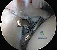 صورة طبية: إصلاح وتر تحت الكتف بالمنظار في صنعاء: دليل شامل من الأستاذ الدكتور محمد هطيف