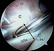 صورة طبية: إصلاح وتر تحت الكتف بالمنظار في صنعاء: دليل شامل من الأستاذ الدكتور محمد هطيف