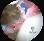 صورة طبية: إصلاح وتر تحت الكتف بالمنظار في صنعاء: دليل شامل من الأستاذ الدكتور محمد هطيف