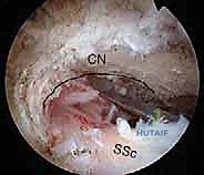 صور الرنين المغناطيسي للكتف