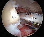 صورة طبية: إصلاح وتر تحت الكتف بالمنظار في صنعاء: دليل شامل من الأستاذ الدكتور محمد هطيف