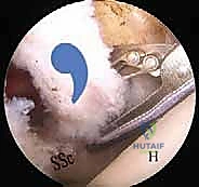 صورة طبية: إصلاح وتر تحت الكتف بالمنظار في صنعاء: دليل شامل من الأستاذ الدكتور محمد هطيف