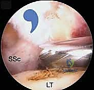 صورة توضيحية لـ إصلاح وتر تحت الكتف بالمنظار في صنعاء: دليل شامل من الأستاذ الدكتور محمد هطيف