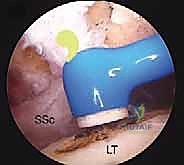 صورة طبية: إصلاح وتر تحت الكتف بالمنظار في صنعاء: دليل شامل من الأستاذ الدكتور محمد هطيف