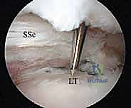 صورة طبية: إصلاح وتر تحت الكتف بالمنظار في صنعاء: دليل شامل من الأستاذ الدكتور محمد هطيف