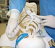 صورة توضيحية لـ إصلاح وتر تحت الكتف بالمنظار في صنعاء: دليل شامل من الأستاذ الدكتور محمد هطيف