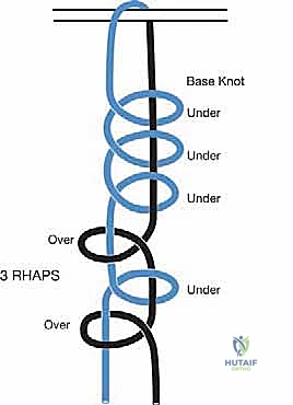 إصلاح وتر تحت الكتف بالمنظار في صنعاء: دليل شامل