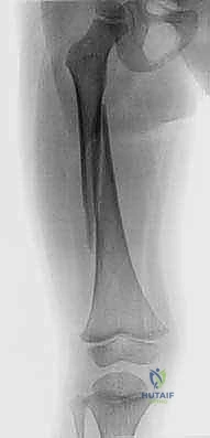 الرد المغلق لكسر الفخذ قبل وضع الجبيرة