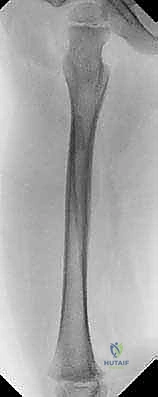 تطبيق الجبيرة الجبسية سبايكا خطوة بخطوة