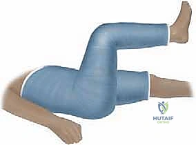 كسر عظم الفخذ عند الأطفال العلاج بالجبيرة الجبسية (سبايكا)