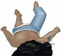 Pediatric Femur Fracture: Closed Reduction & Spica Casting Masterclass