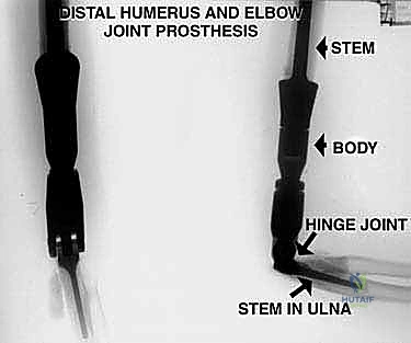 صورة توضيحية لـ استئصال ورم عظم العضد البعيد وإعادة بناء مفصل الكوع بالطرف الصناعي: دليل شامل للمرضى مع الأستاذ الدكتور محمد هطيف