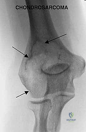 صورة توضيحية لـ استئصال ورم عظم العضد البعيد وإعادة بناء مفصل الكوع بالطرف الصناعي