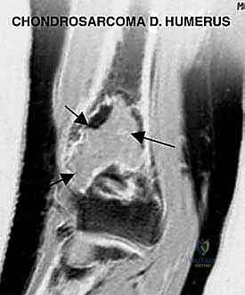 التشريح الدقيق وموقع الأورام في عظم العضد البعيد