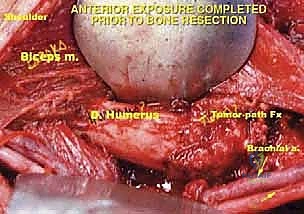 التخطيط الجراحي الدقيق قبل العملية وتحديد هوامش القطع