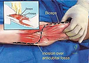 صورة توضيحية لـ استئصال ورم عظم العضد البعيد وإعادة بناء مفصل الكوع بالطرف الصناعي: دليل شامل للمرضى مع الأستاذ الدكتور محمد هطيف