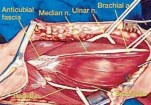 الشق الجراحي والنهج المتبع للوصول إلى الورم بأمان