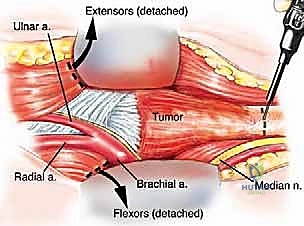 التشخيص الإشعاعي الدقيق وتحديد امتداد الورم في العضد