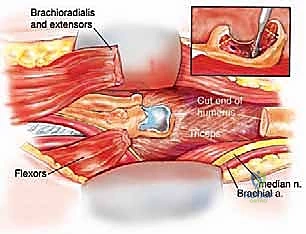 تجهيز القناة النخاعية للبدء في تركيب الطرف الصناعي