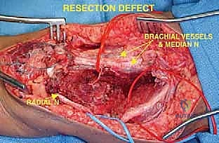 استئصال الورم العظمي من العضد البعيد - الجزء الأول