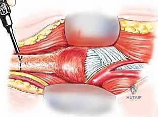 الكتلة الورمية والعظم المستأصل بالكامل كقطعة واحدة