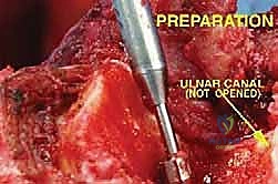 صورة توضيحية لـ استئصال ورم عظم العضد البعيد وإعادة بناء مفصل الكوع بالطرف الصناعي: دليل شامل للمرضى مع الأستاذ الدكتور محمد هطيف