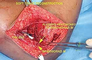 صورة توضيحية لـ استئصال ورم عظم العضد البعيد وإعادة بناء مفصل الكوع بالطرف الصناعي: دليل شامل للمرضى مع الأستاذ الدكتور محمد هطيف