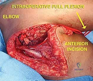 صورة توضيحية لـ استئصال ورم عظم العضد البعيد وإعادة بناء مفصل الكوع بالطرف الصناعي: دليل شامل للمرضى مع الأستاذ الدكتور محمد هطيف