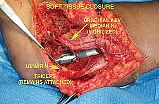استئصال ورم عظم العضد البعيد وإعادة بناء مفصل الكوع بالطرف الصناعي: دليل شامل للمرضى مع الأستاذ الدكتور محمد هطيف