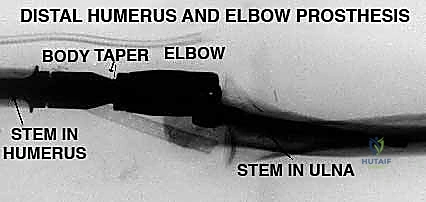 Distal Humeral Tumor Resection & Prosthetic Elbow Reconstruction: An Operative Masterclass
