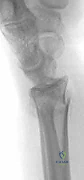 مقارنة بين الجبس والتثبيت الجراحي