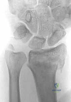 تثبيت كسر الكعبرة البعيدة بالشريحة الظهرية في صنعاء