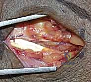 رد الكسر تحت جهاز الأشعة اللحظي