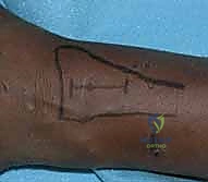 تطور الشرائح الظهرية المنخفضة السماكة