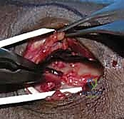 تثبيت كسر الكعبرة البعيدة بالشريحة الظهرية: دليل المريض الشامل وخبرة الأستاذ الدكتور محمد هطيف في صنعاء