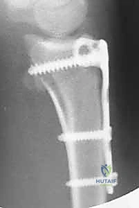 تشريح مفصل الرسغ وعظم الكعبرة