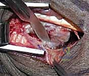 Intraoperative Surgical Step