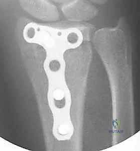 تخطيط جراحي دقيق للكسر