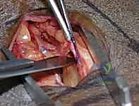 صورة توضيحية لـ تثبيت كسر الكعبرة البعيدة بالشريحة الظهرية: دليل المريض الشامل وخبرة الأستاذ الدكتور محمد هطيف في صنعاء