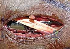 الشق الجراحي الظهري الدقيق