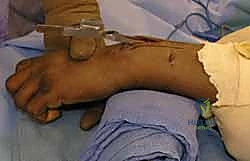 التأكد من استواء سطح المفصل