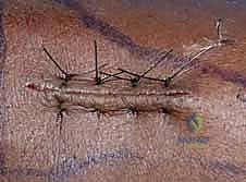 صورة توضيحية لـ تثبيت كسر الكعبرة البعيدة بالشريحة الظهرية: دليل المريض الشامل وخبرة الأستاذ الدكتور محمد هطيف في صنعاء