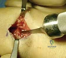 صورة توضيحية لـ تثبيت كسر الكعبرة البعيدة بالشريحة الظهرية: دليل المريض الشامل وخبرة الأستاذ الدكتور محمد هطيف في صنعاء