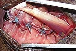 صورة توضيحية لـ تثبيت كسر الكعبرة البعيدة بالشريحة الظهرية: دليل المريض الشامل وخبرة الأستاذ الدكتور محمد هطيف في صنعاء