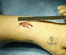 صورة توضيحية لـ تثبيت كسر الكعبرة البعيدة بالشريحة الظهرية: دليل المريض الشامل وخبرة الأستاذ الدكتور محمد هطيف في صنعاء